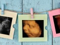 ۸ سوال رایج در سونوگرافی حاملگی-سلامت بانوان اوما