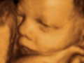 آیا سونوگرافی سه بعدی (۳D) و چهار بعدی (۴D) برای جنین ضرر دارد؟