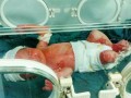 خبر سوختگی نوزاد ۳ روزه تایید شد  عکس