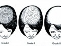 ریزش مو ، درمان ريزش مو :۵ علت ریزش موی خانم ها