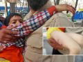 قطع انگشتان کودک ۷ساله برای حمله سگ درکمپ نوروزی+عکس