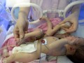 موفقیت جراحی نوزاد عجیب ۸ دست و پایی ! + عکس