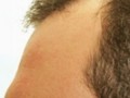 ابزار FUE و کاربردشان - کلینیک تخصصی پوست و موی آرمان