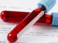 تست تحمل گلوکز ( GTT) یا آزمایش قند خون در بارداری چیست؟