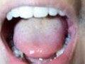 استرس، مهمترین عامل ایجاد آفت دهان | انجمن علمی میکروبیولوژی