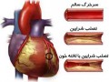 مقاله ای کامل در مورد سکته قلبی | پژوهشکده