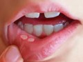 سریعترین روش برای درمان آفت دهان | دکتر پلاس
