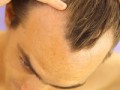 دلایل ریزش مو, درمان ریزش مو و تصاویری از انواع ریزش مو