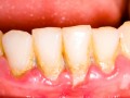 عواملی که باعث زردی دندان ها می شوند