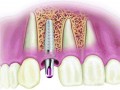 اطلاعاتی درباره ایمپلنت دندان - سایت پزشکی و مجله سلامتی راستینه