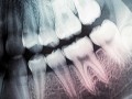 استفاده از لیزر برای ترمیم دندان