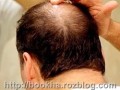 درمان ریزش مو در مردان با راهکار دارویی