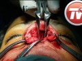 ریتم زندگی-تی وی پلاس - تصاویری از جدیدترین روش عمل جراحی بینی/لطفا اگر طاقتش را ندارید، نبینید-قسمت اول