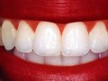 دندان هایی به سفیدی مروارید