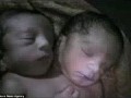 تولد نوزادی با دو سر در هند(تصاویر)