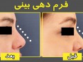 فرم دهی بینی بدون عمل جراحی