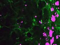تبدیل سلول‌های معمولی پوست به شکارچیان تومور مغزی - روژان